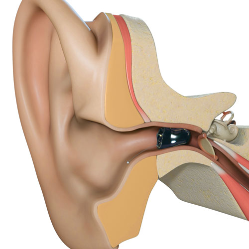 A diagram showing an invisible-in-the-canal hearing aid inside an ear canal